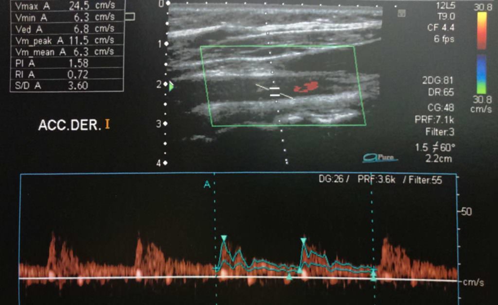 ecografía doppler