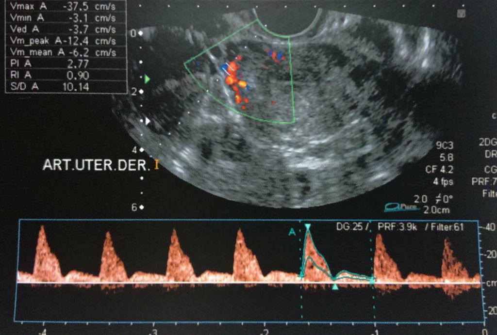 Para qué sirve la ecografía doppler en el embarazo? - Ginefem