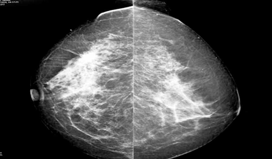 Mama densa como indicador de riesgo del cáncer mamario