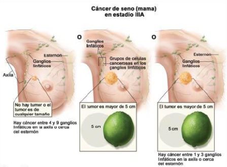 Progresión y metástasis de un cáncer de mama