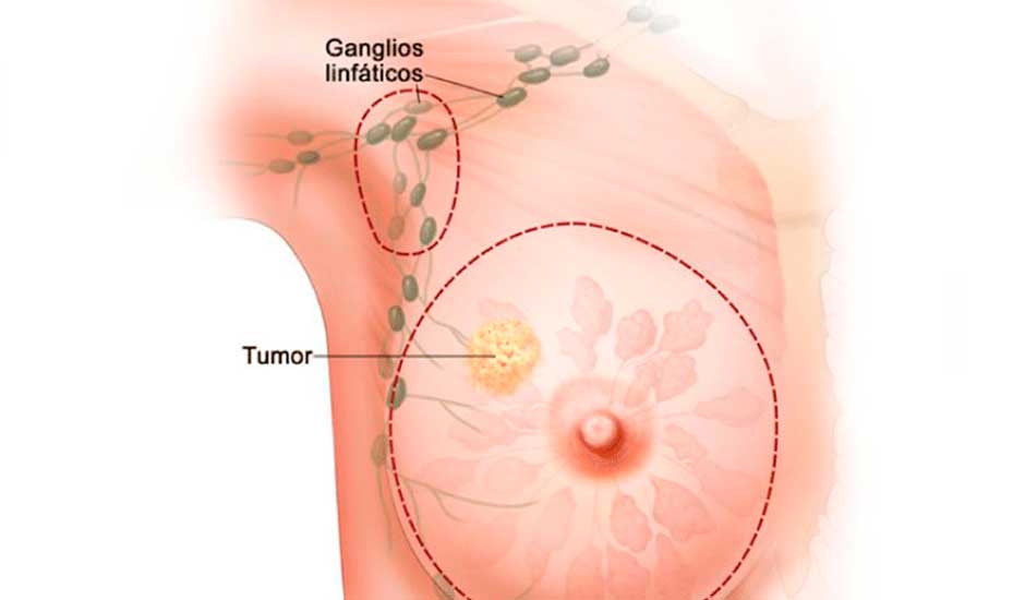 ¿Puede la glándula mamaria generar un cáncer?