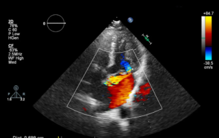imagen de como se ve un eco doppler color cardíaco