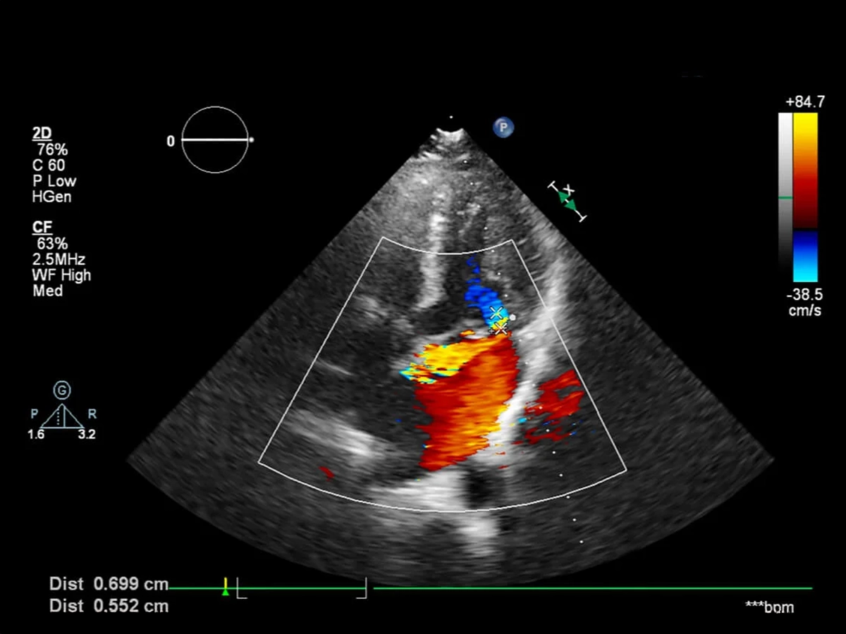 ¿Qué es y cómo se hace un Eco Doppler color cardíaco?