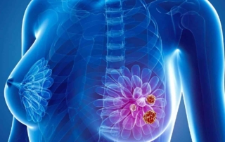 ecografia de cancer de mama
