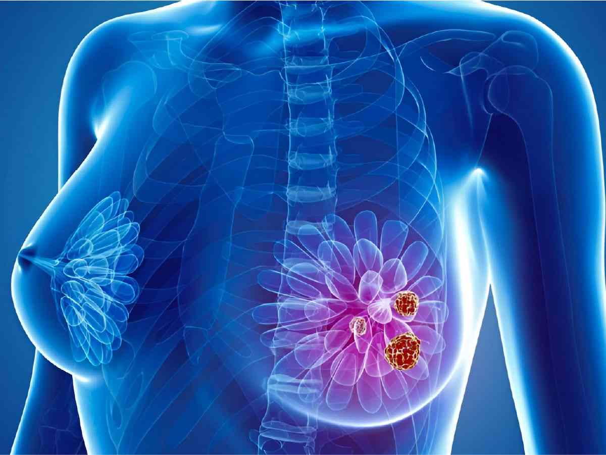 ecografia de cancer de mama