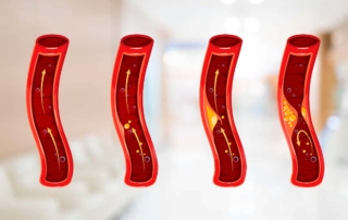 ¿Qué es la trombosis arterial?