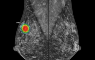 La inteligencia artificial en la lectura de mamografias