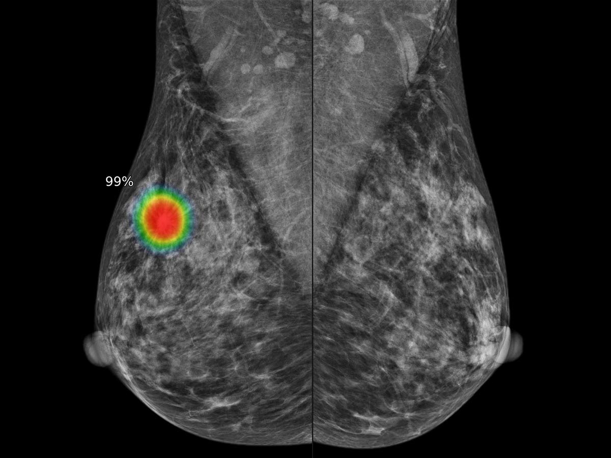 La inteligencia artificial en la lectura de mamografias