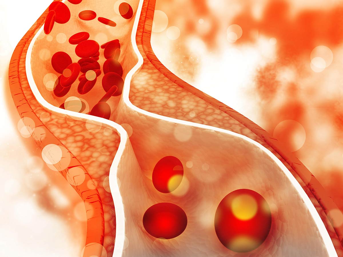Enfermedad Vascular Periferica