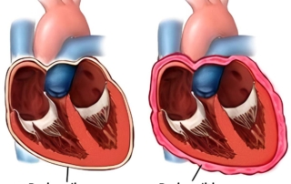 Pericarditis : Síntomas, Causas y Tratamiento | Diagnóstico Rojas