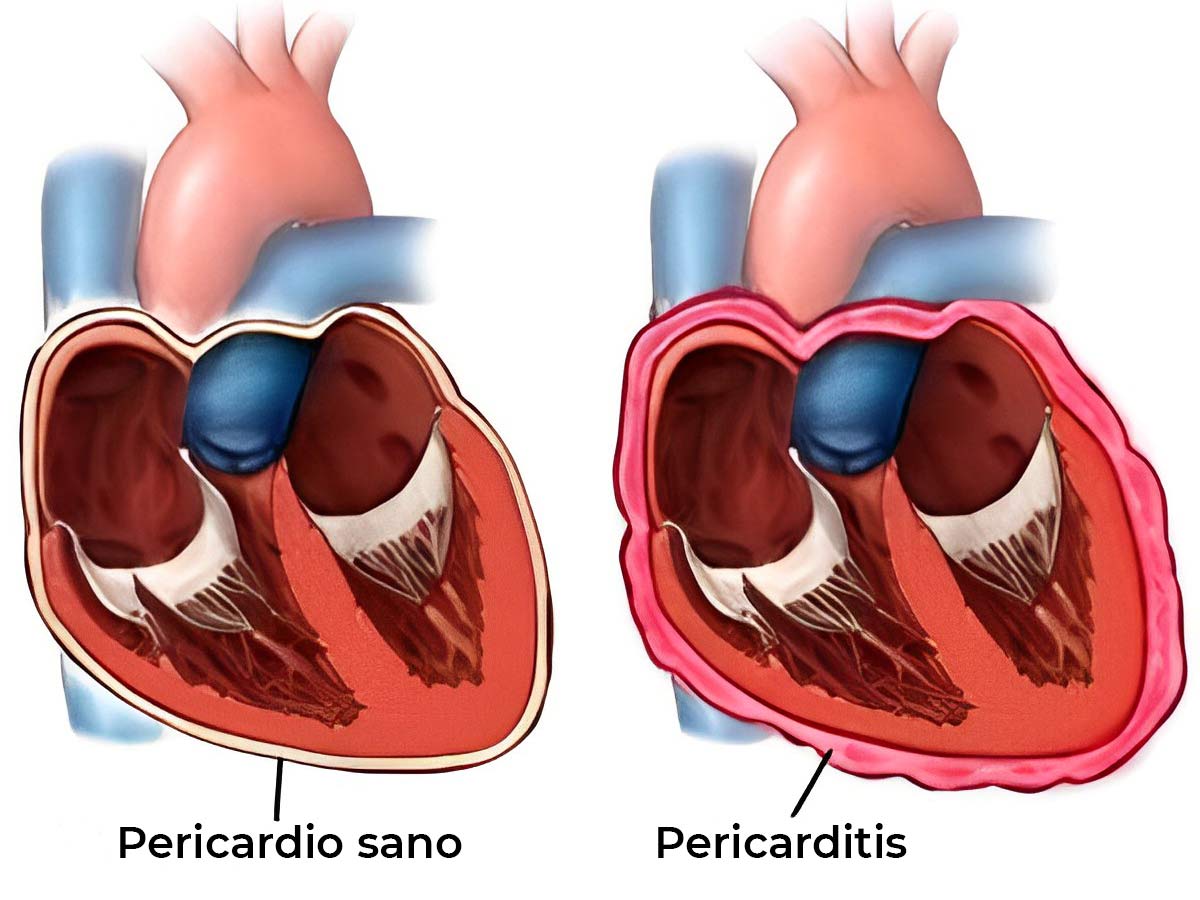 Pericarditis : Síntomas, Causas y Tratamiento | Diagnóstico Rojas