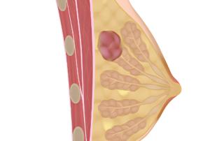 Lipoma Mamario: Síntomas, Causa y Tratamiento |