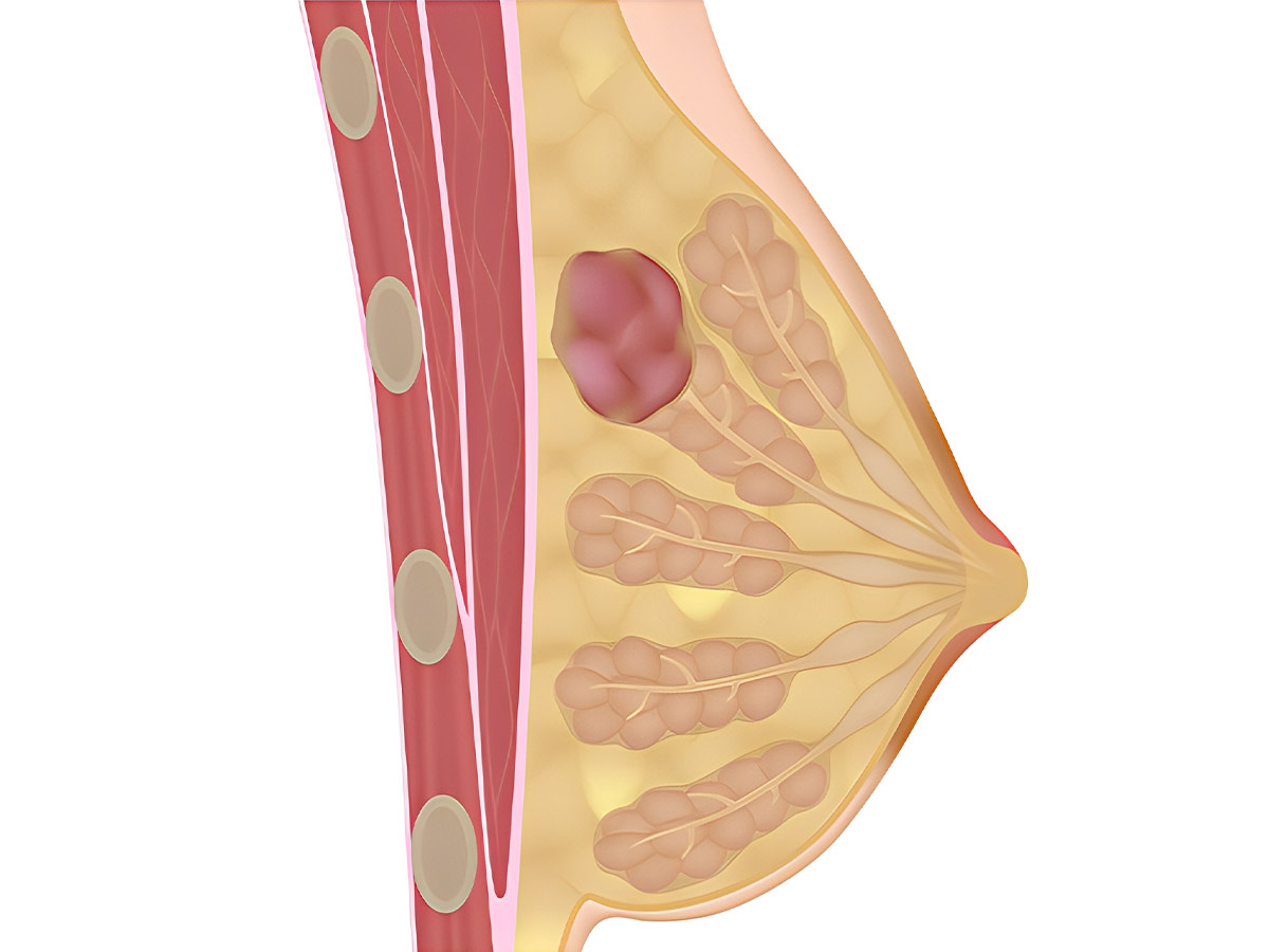 Lipoma Mamario: Síntomas, Causa y Tratamiento |