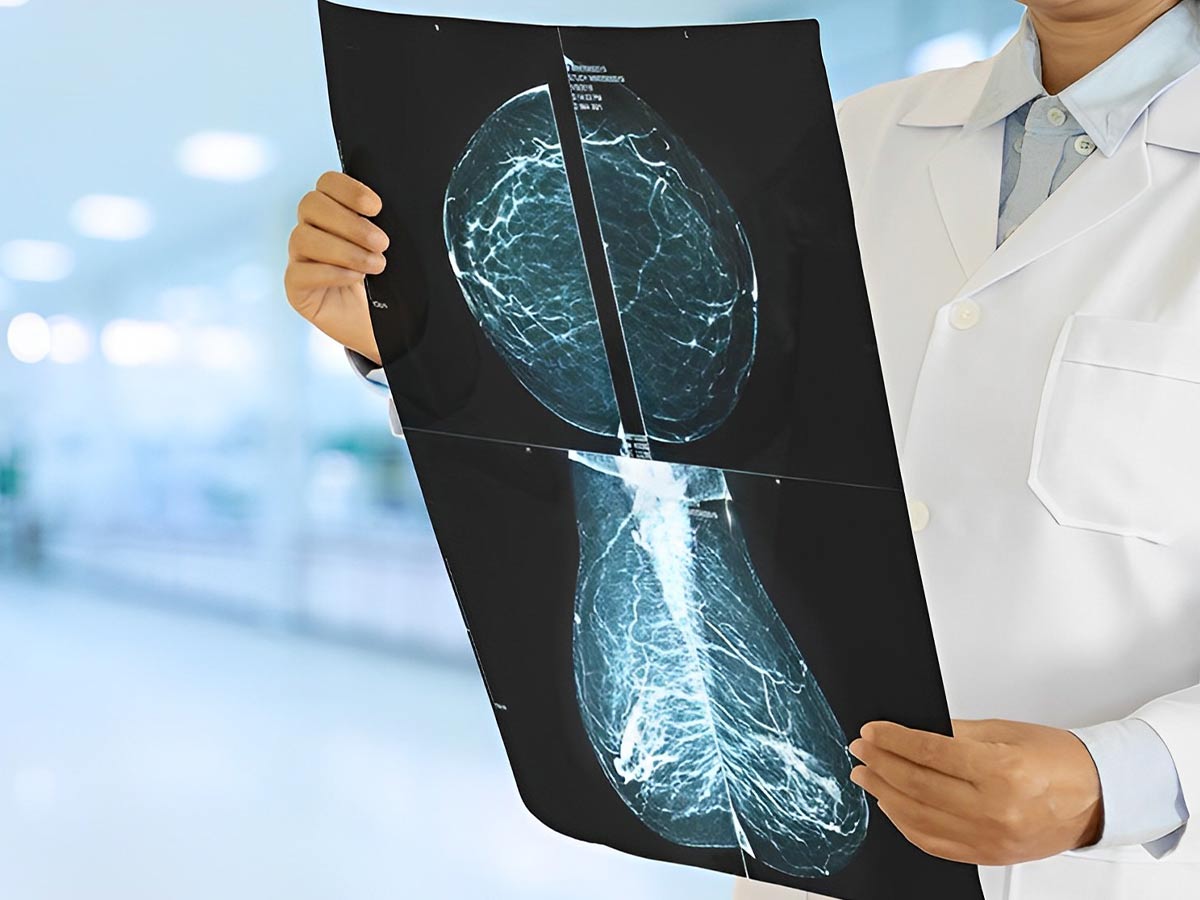 Carcinoma Ductal In Situ: Causas y Tratamientos