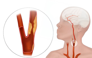 Estenosis carotídea: Qué es, Síntomas y tratamiento