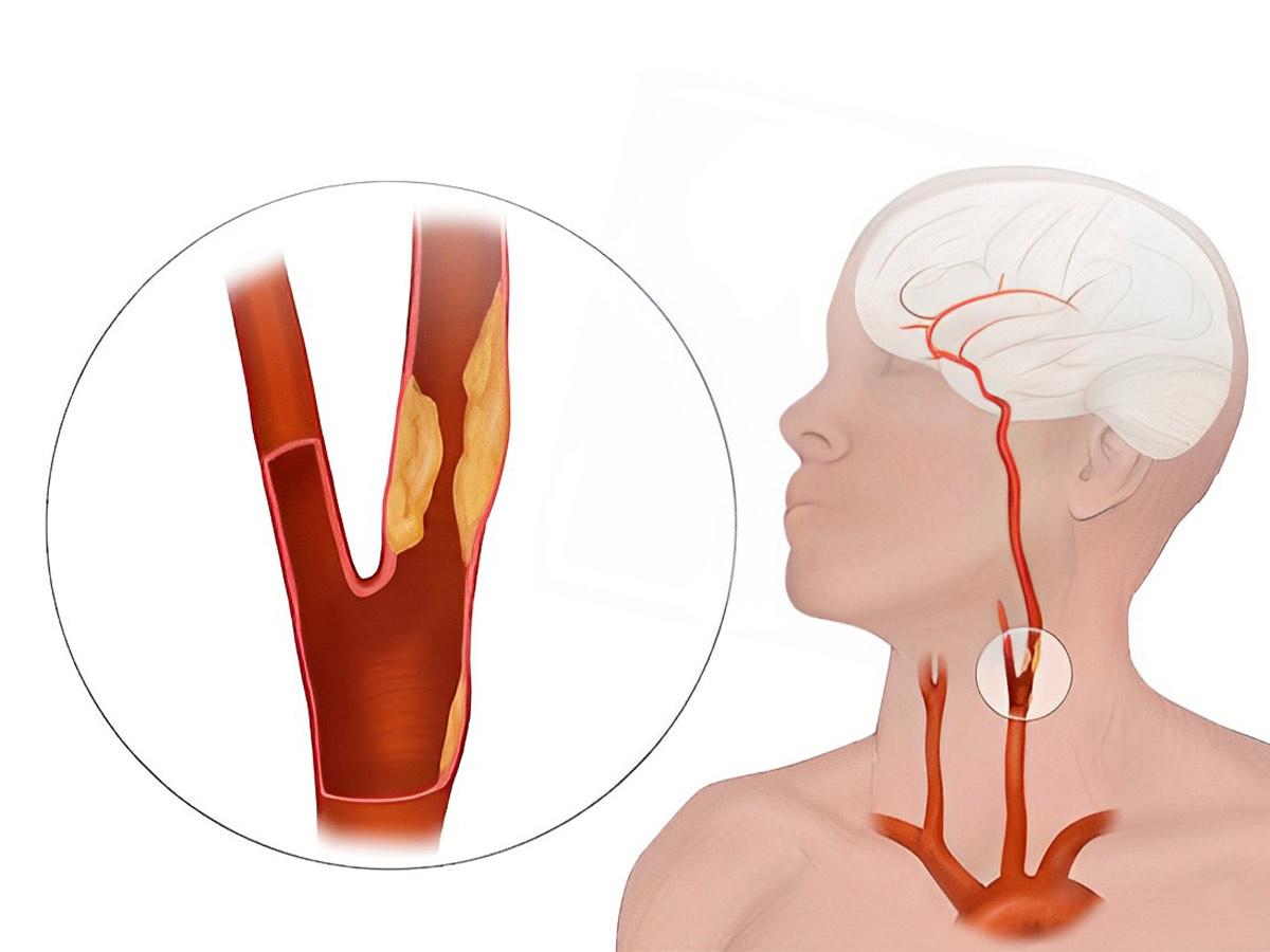 Estenosis carotídea: Qué es, Síntomas y tratamiento