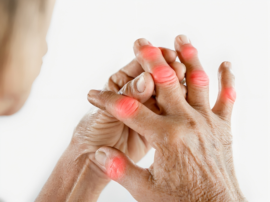 artritis reumatoides
