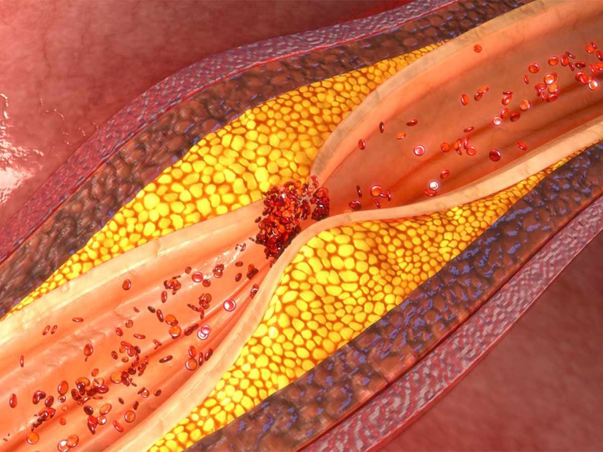 Arteritis