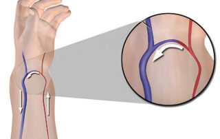 Fistulas arteriovenosas