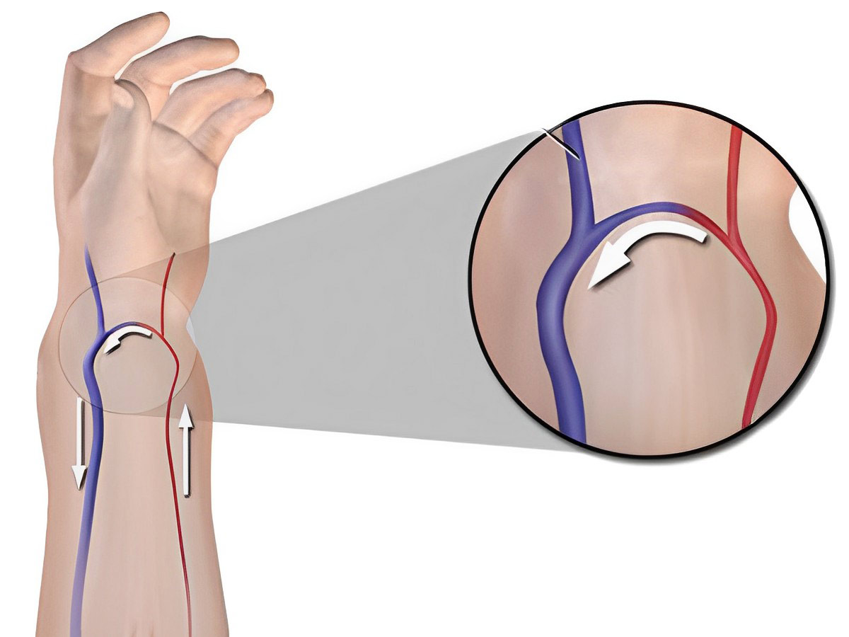 Fistulas arteriovenosas