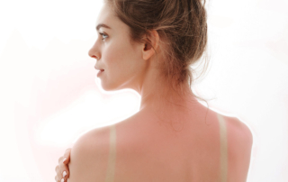 Quemaduras Solares