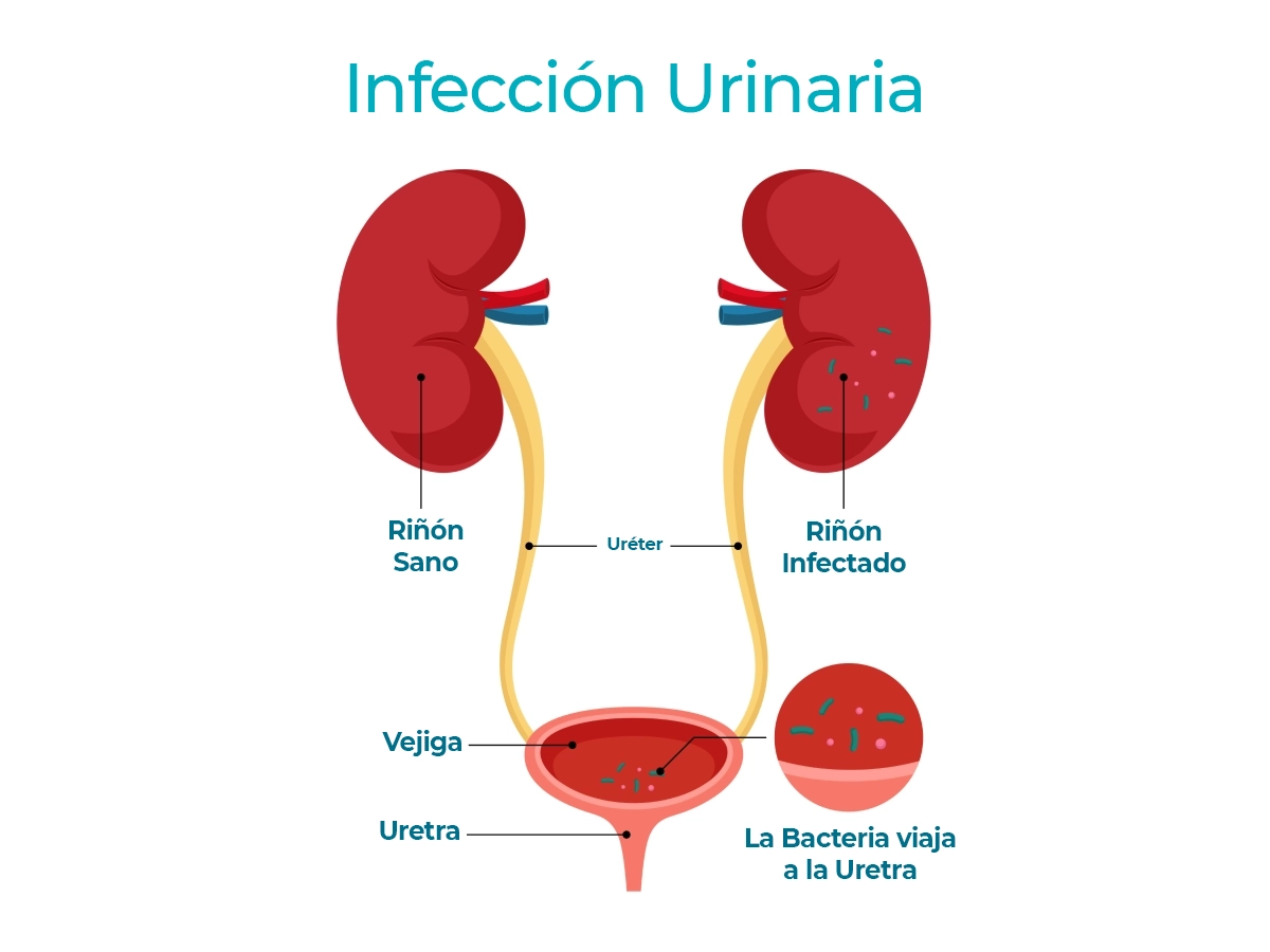 Infografía de una infección urinaria en embarazadas