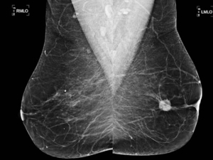 Estudio por imágen para detectar fibroadenomas