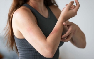 Persona con síntomas de dermatitis atópica