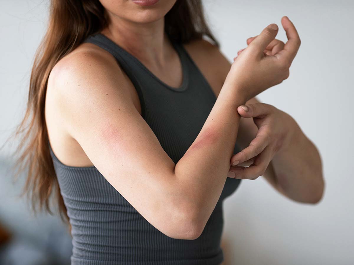 Persona con síntomas de dermatitis atópica