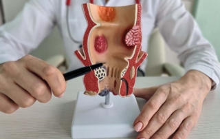 Especialista explicando con una figura qué son las hemorroides