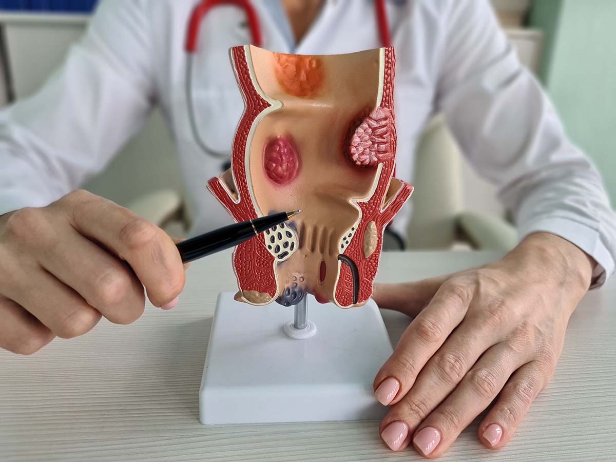 Especialista explicando con una figura qué son las hemorroides