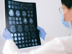 Resonancia magnética en el cáncer cerebral