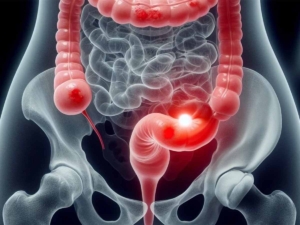 Tratamiento cáncer colorrectal