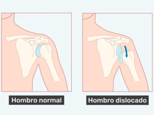Imagen representativa de un hombro dislocado