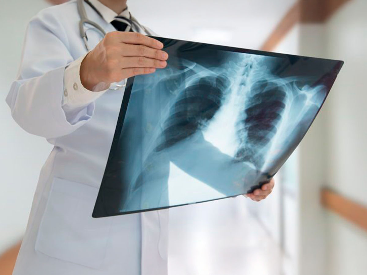 Qué enfermedades detecta una radiografía