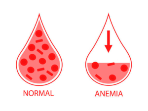 Anemia aplásica cómo se mide