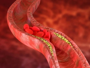 Imagen representativa de la ateroesclerosis