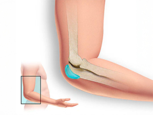 Infografía de una bursitis