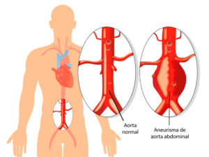Imagen representativa de un aneurisma aórtico torácico