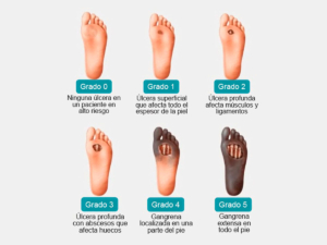 Infografía de los grados del pie diabético