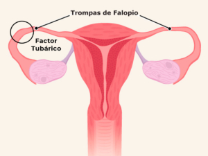 Imagen representativa trompas de falopio