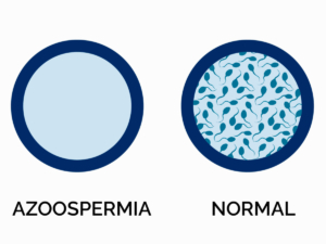 Imagen representativa de la azoospermia