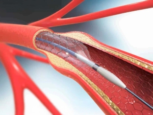 Imagen de un stent por angioplastia