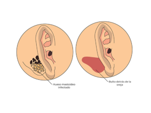 Infografía sobre la mastoiditis
