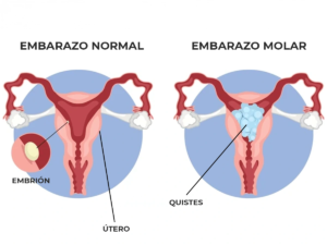 Infografía de un embarazo molar