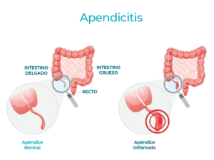 Infografía sobre los síntomas de apendicitis en mujeres