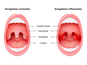 Infografía sobre la inflamación de amígdala 
