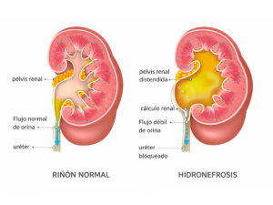 hinchazón o dilatación de uno o ambos riñones provocada por la acumulación de orina
